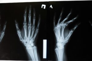 Depo Provera Bone Loss Lawsuit - Featured image