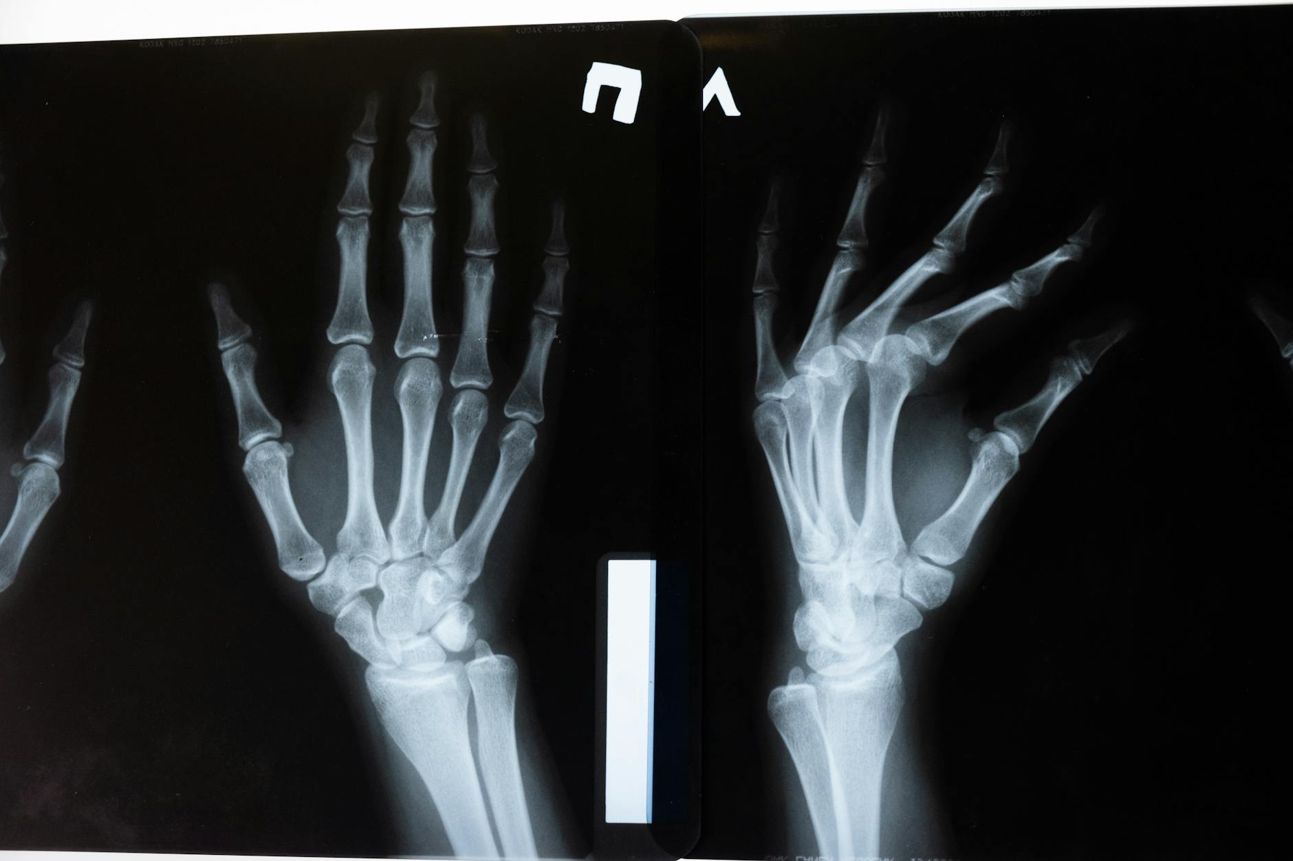 Depo Provera Bone Loss Lawsuit - Featured image