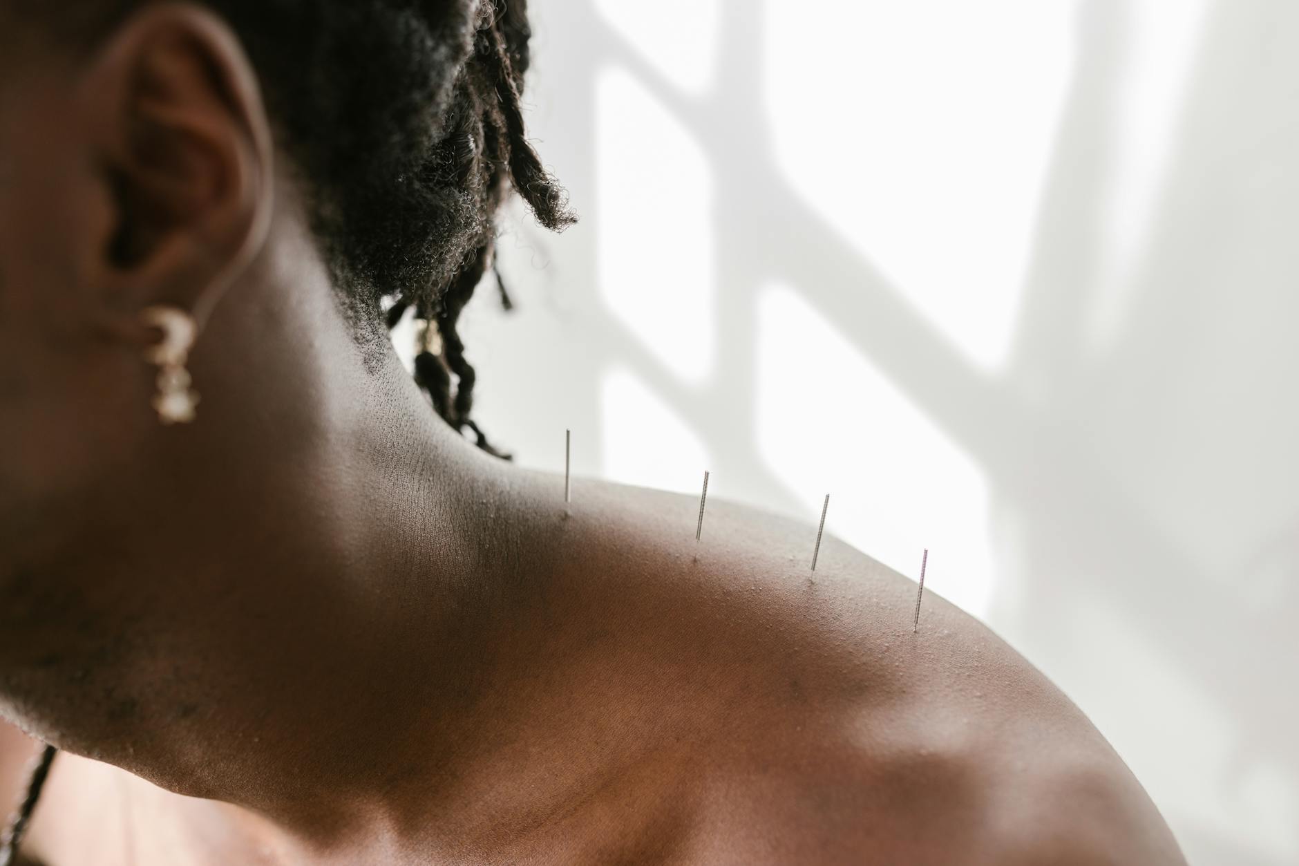 Acupuncture Malpractice Lawsuit - Featured image