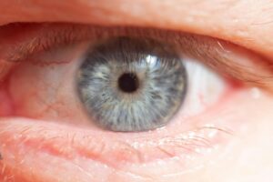 Corneal Transplant Lawsuit - Featured image