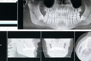 Dental Bone Graft Lawsuit - Featured image