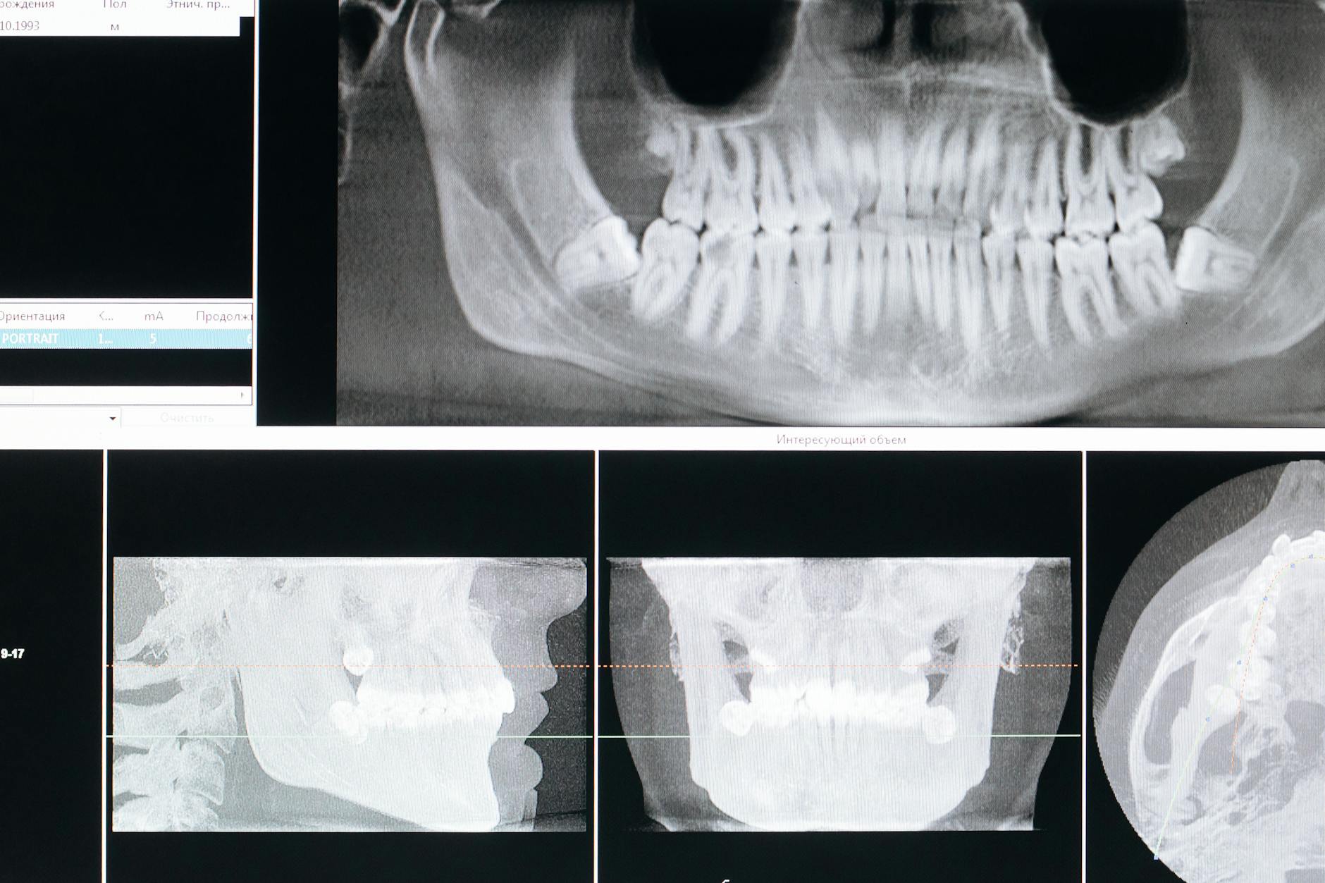 Dental Bone Graft Lawsuit - Featured image