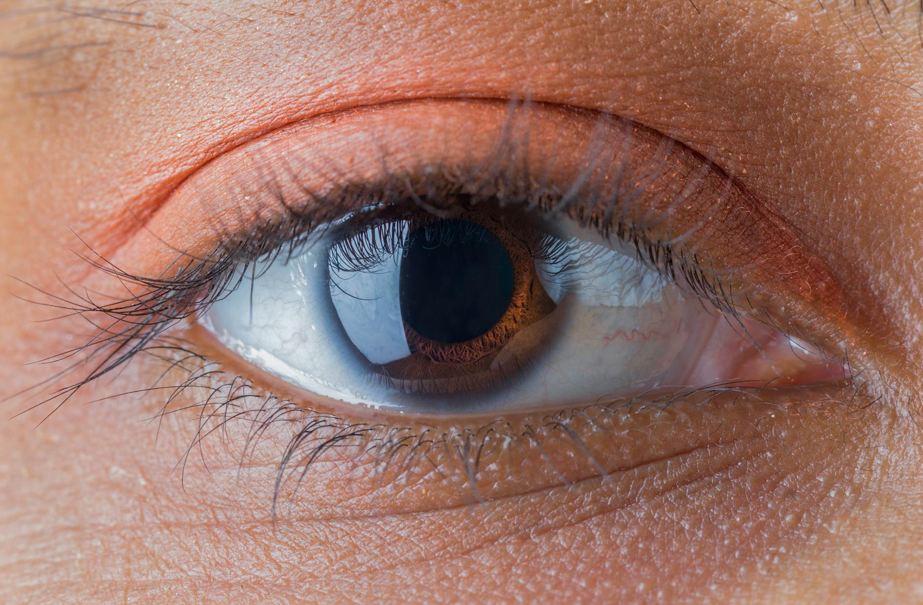 How Common Is Cataract Surgery Malpractice Litigation?