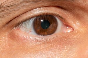 Lens Implant Defect Lawsuit - Featured image