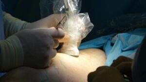 Liposuction Death Lawsuit - Featured image