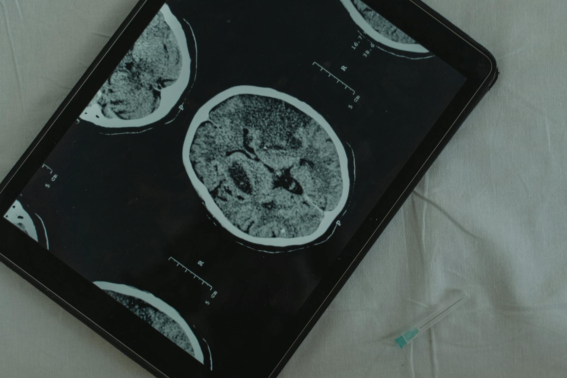 Meningitis Misdiagnosis Lawsuit - Featured image