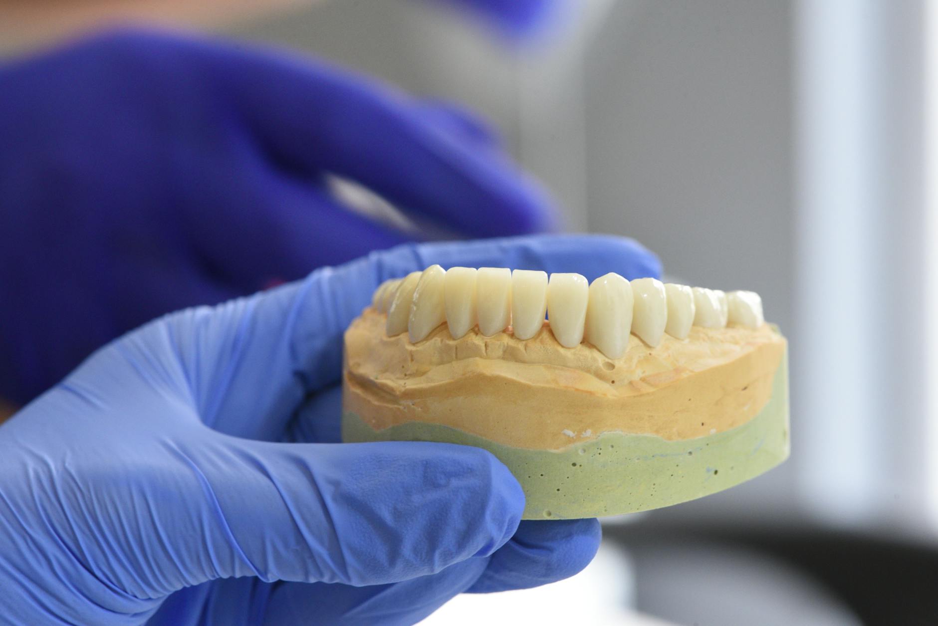 Recent Dental Implant Failure Cases and Litigation Trends