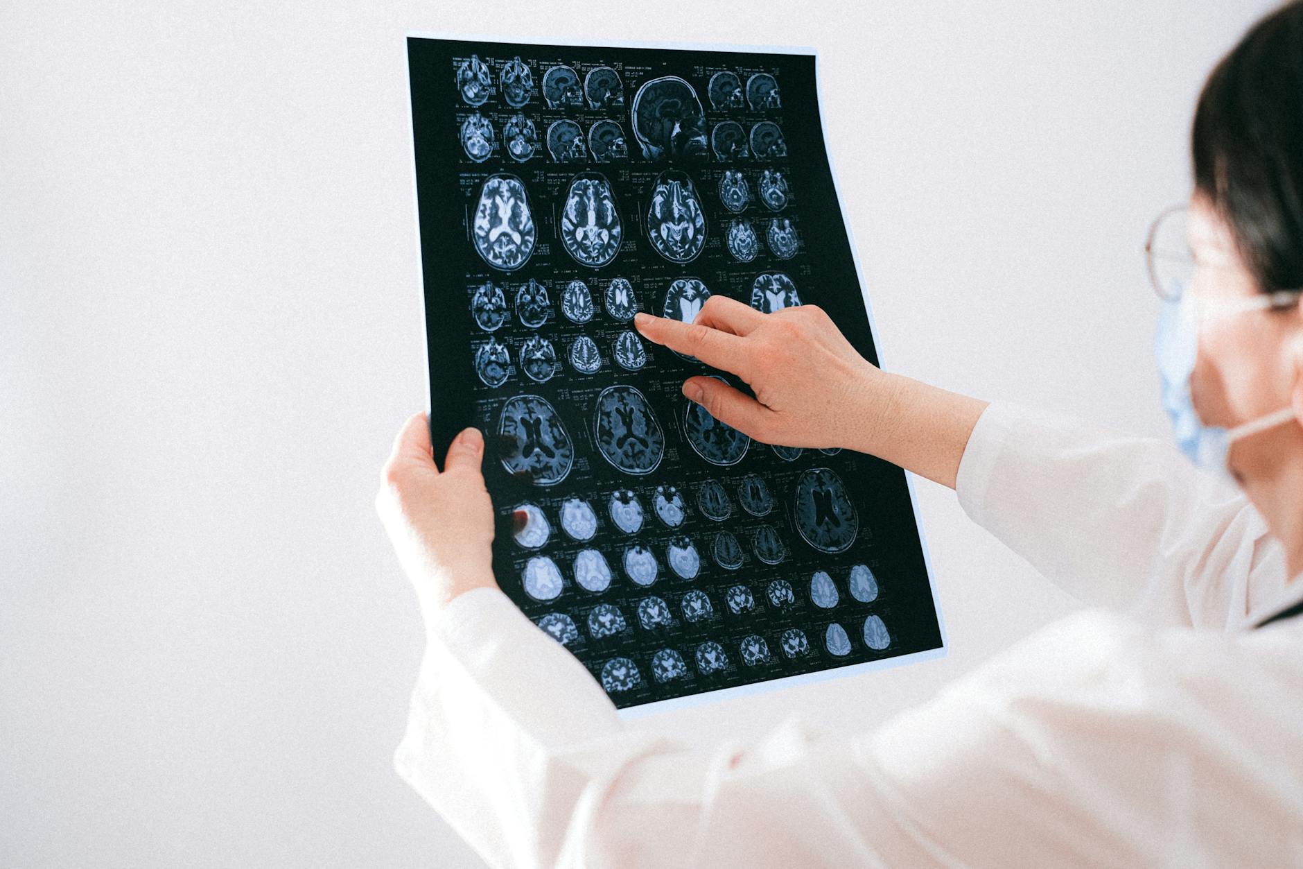 Stroke Misdiagnosis Lawsuit - Featured image