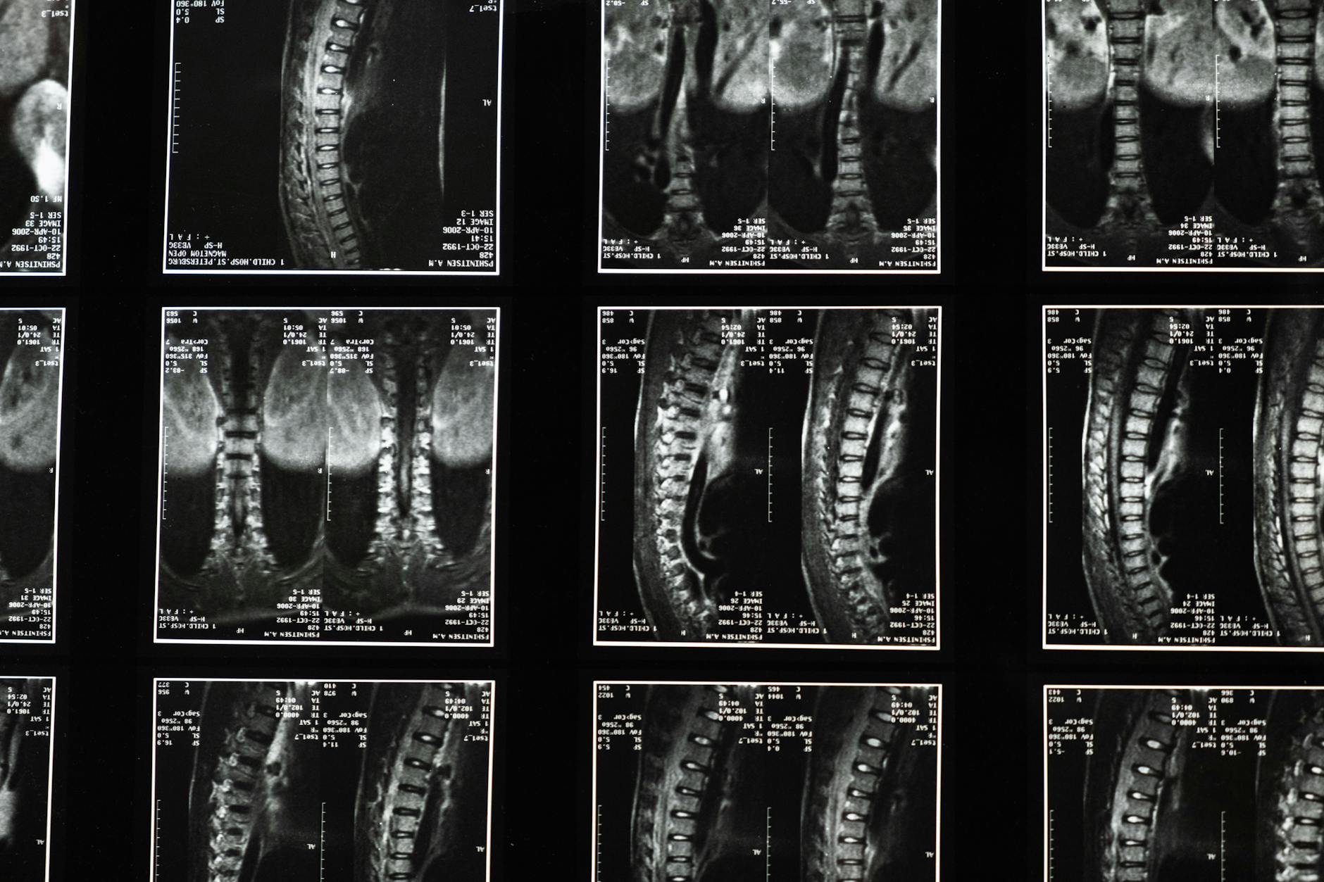 THE GEORGIA BONE NECROSIS CASE AND SERIOUS TREATMENT FAILURES