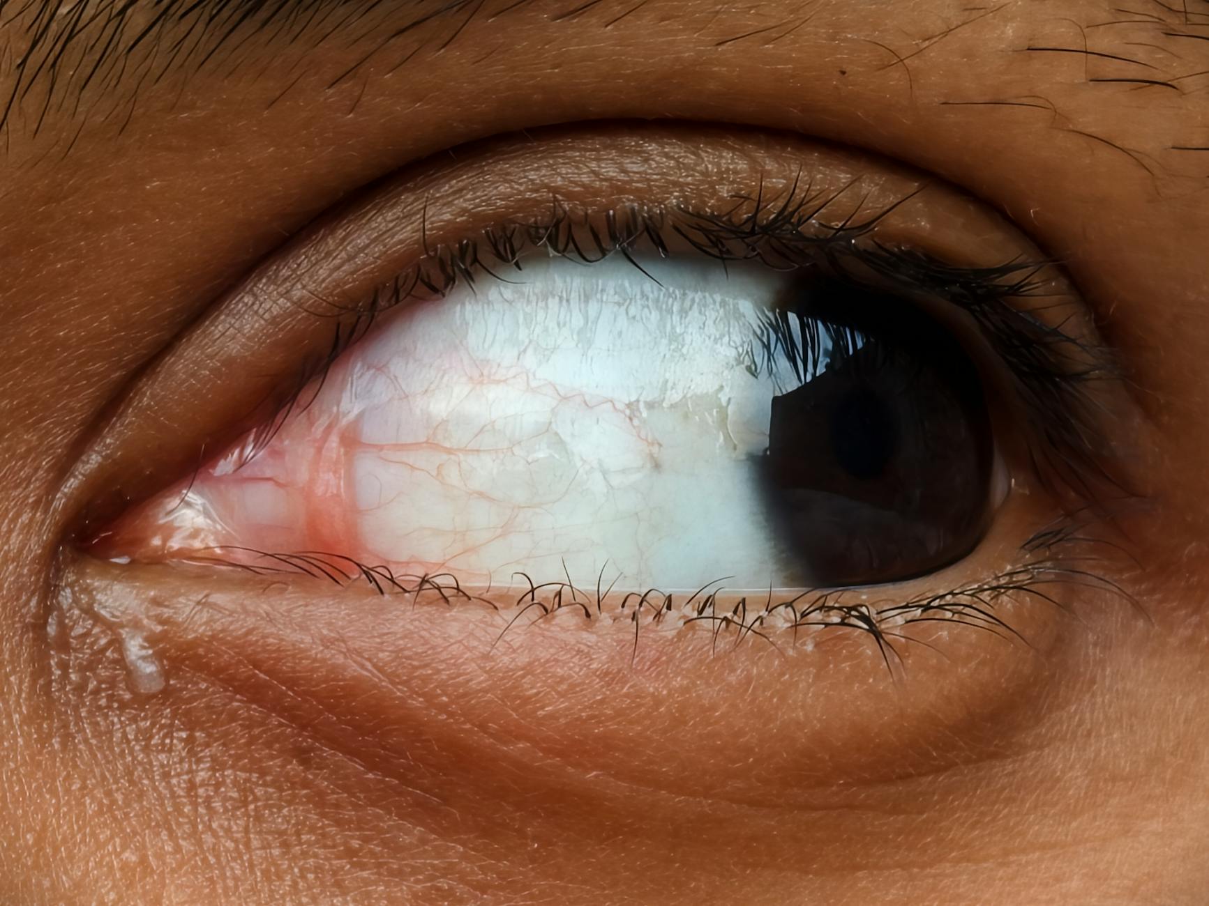 What Types of Glaucoma Surgeries Are Subject to Lawsuits?