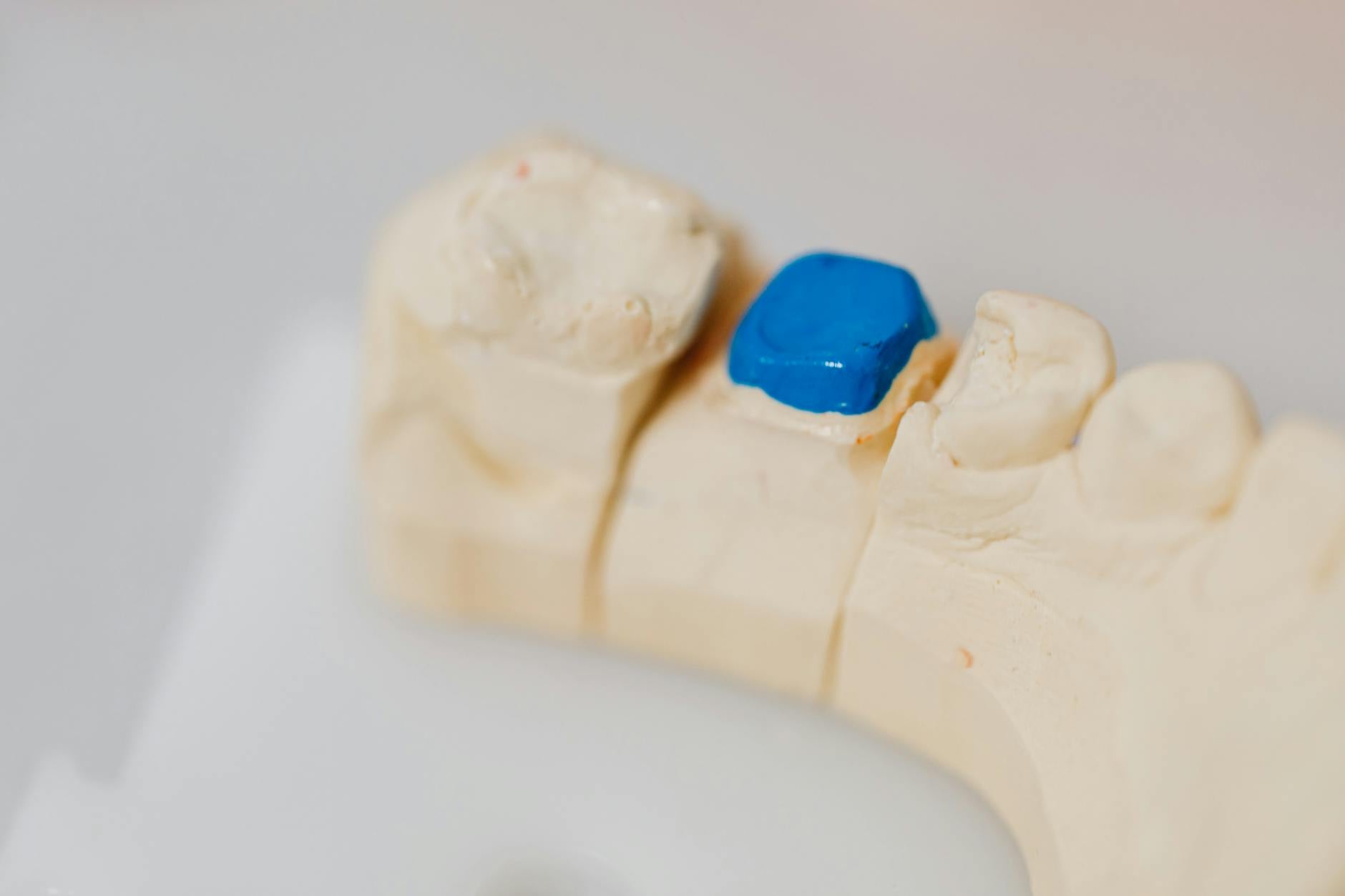 When Does a Dental Bridge Fail and Become a Legal Issue?