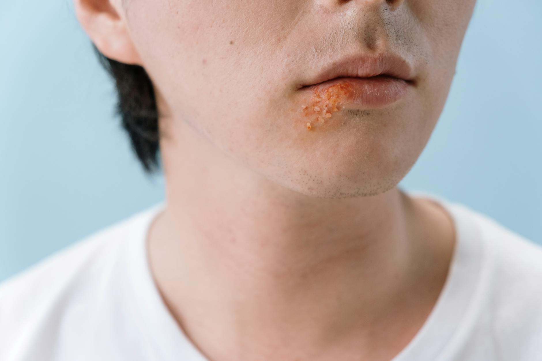 Why Is Oral Cancer Frequently Misdiagnosed by Dentists?
